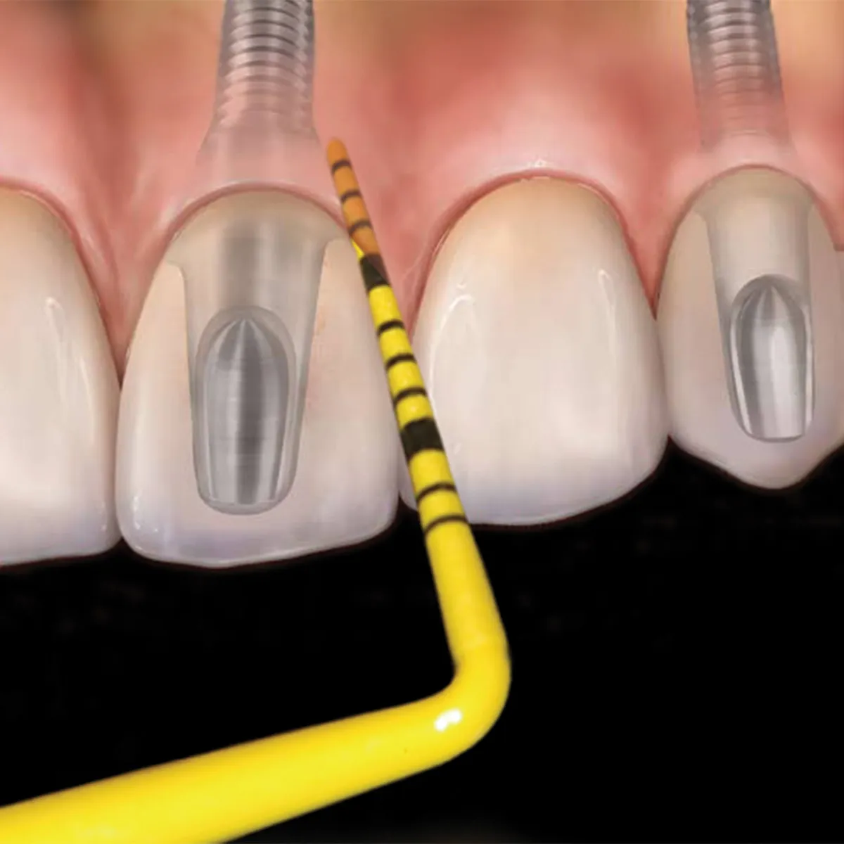 Colorvue Probe Tips #UNC 12, PK/12