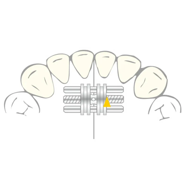 VECTOR 90, Skeletal Expanders, 4mm, PK/10
