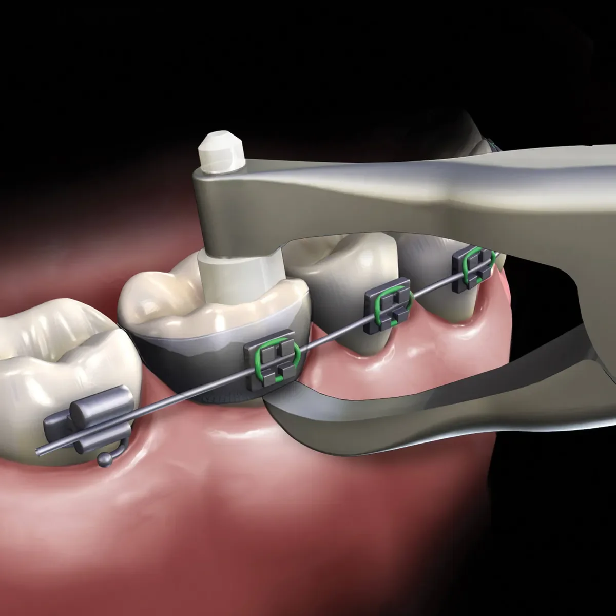 Slim Posterior Band Removing Plier