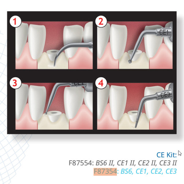 Crown Extension Kit, 4 Tips - Acteon - F87354